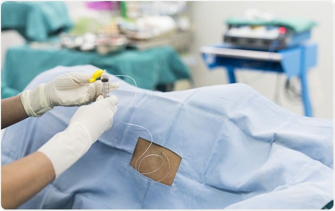 Epidural nerve block. Image Credit: ChaNaWiT / Shutterstock